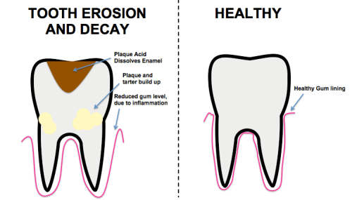 emanel erosion costa rica dental prices